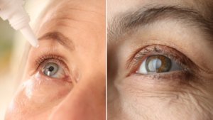 Glaucoma vs Cataracts: Key Differences Explained