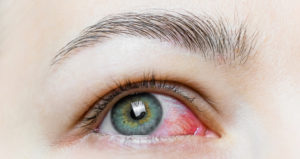 A close-up of a bloodshot eye