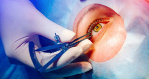 A close-up of an eye doctor's hand holding a device up to a patient's eye. The patient has a sheet over their face exposing the eye only.