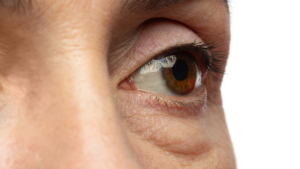 What Causes Bags Under Your Eyes?