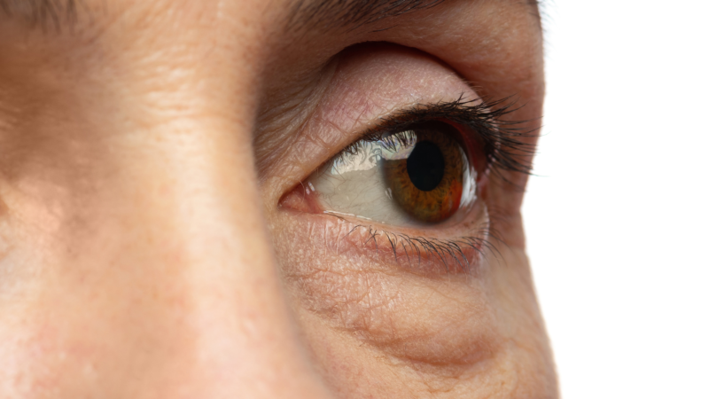 What Causes Bags Under Your Eyes?