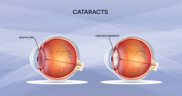 Cataracts | Florida Eye Specialists