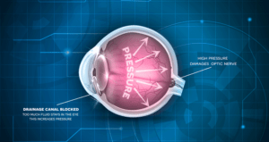 5 Things You Should Know About Glaucoma | Florida Eye Specialist