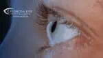 Now Available_ Groundbreaking Keratoconus Treatment