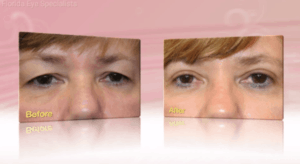 What You Need To Know About Blepharoplasty | Florida Eye Specialists