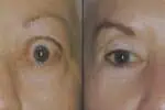 A before and after photo of a Thyroid Eye Disease patients eyes