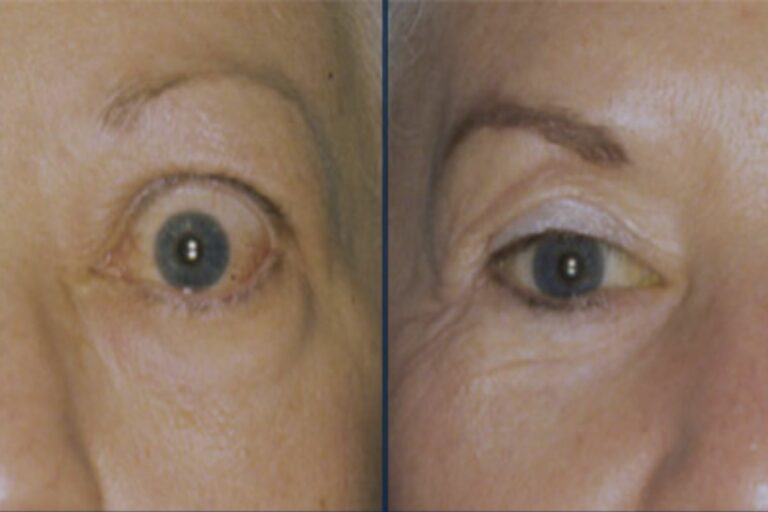 A before and after photo of a Thyroid Eye Disease patients eyes