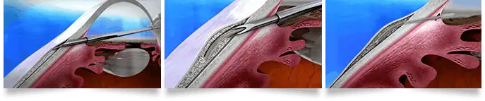 Xen Gel Stent Florida Eye Specialists
