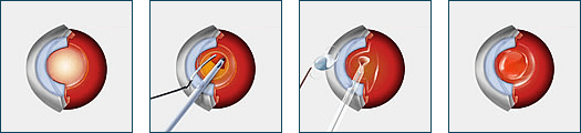 Cataract Surgery Diagram