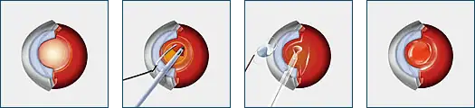 Cataract Surgery Diagram