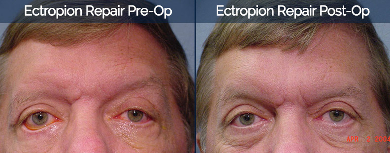 Ectropion Repair Before & After 2