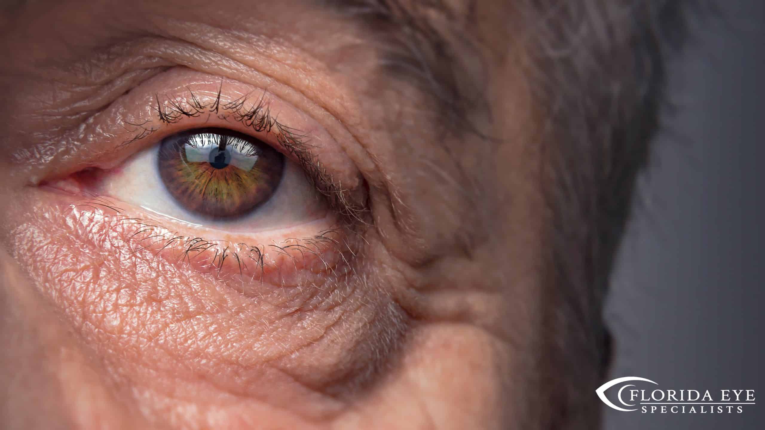 Training Eyes After Cataract Surgery Florida Eye Specialists