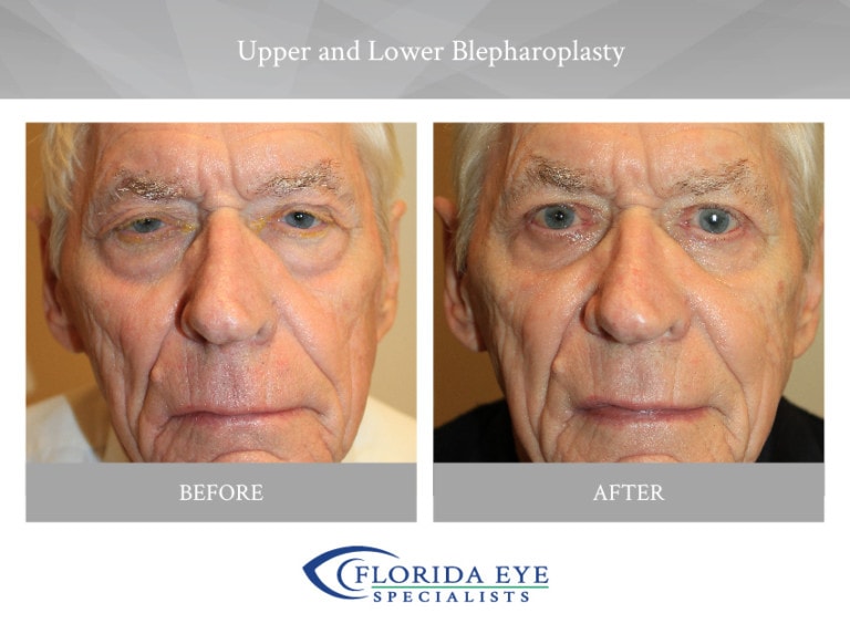 Older Man Upper and Lower Blepharoplasty