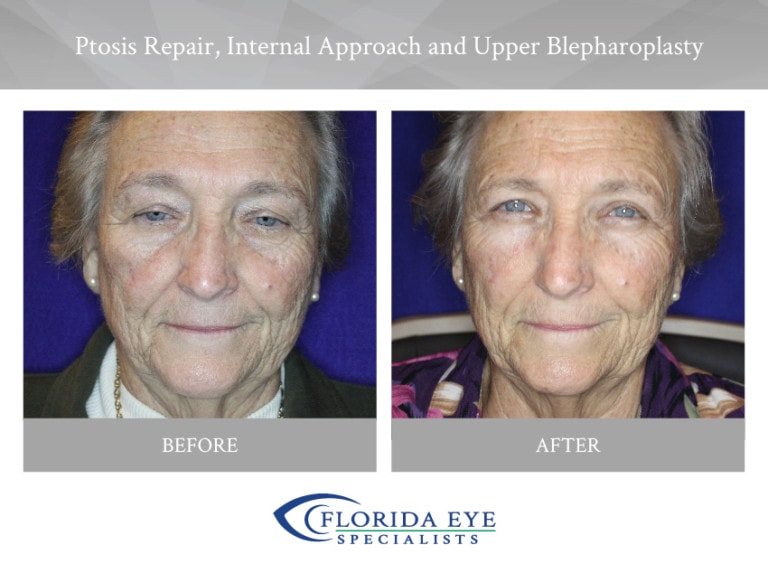 Ptosis Repair Internal Approach and Upper Blepharoplasty