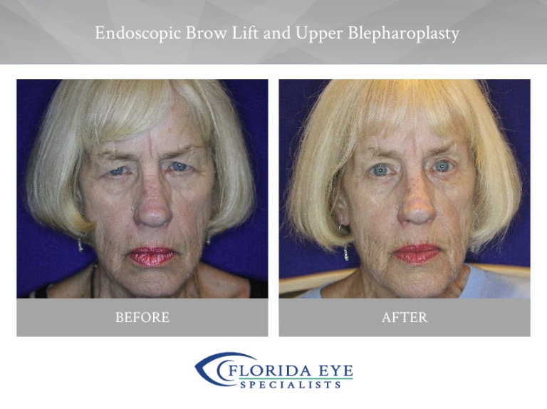 Endoscopic Brow Lift and Upper Blepharoplasty