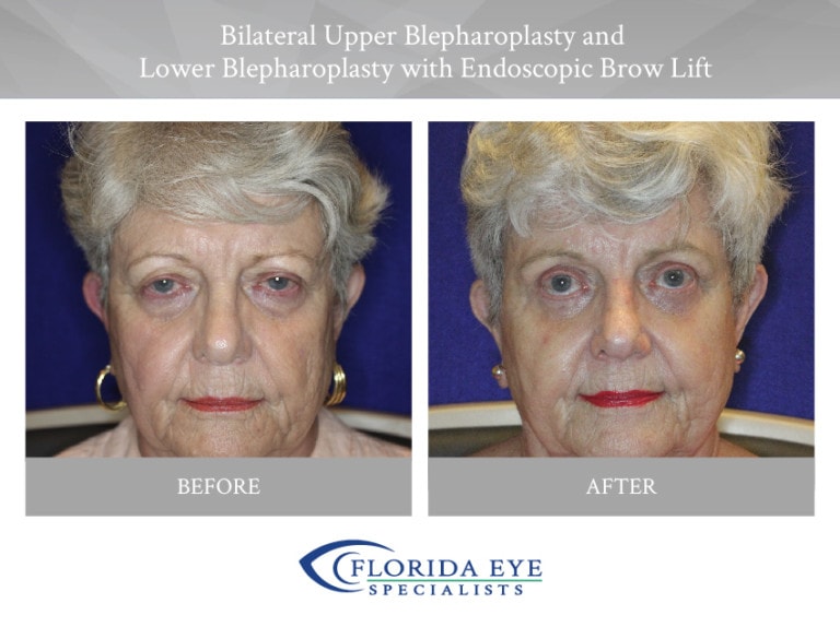 Bilateral Upper Blepharoplasty Lower Blepharoplasty with Endoscopic Brow Lift