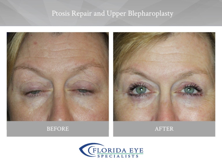 Ptosis Repair Upper Blepharoplasty Florida Eye Specialists