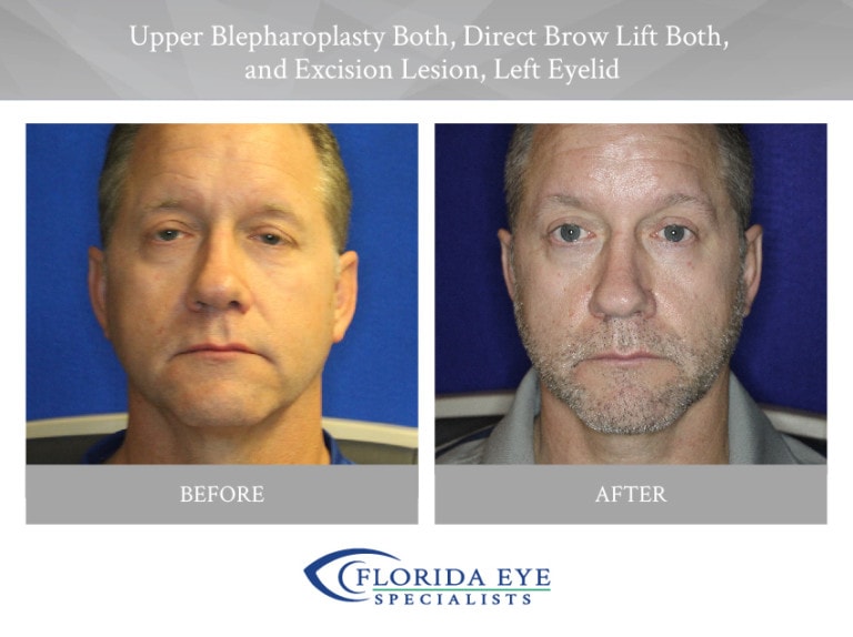 Upper Blepharoplasty Direct Brow Lift Excision Lesion