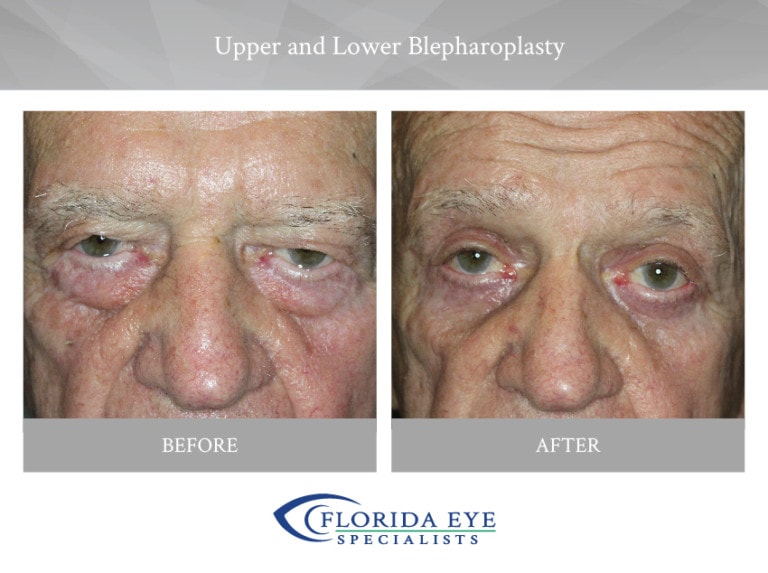 Upper and Lower Blepharoplasty