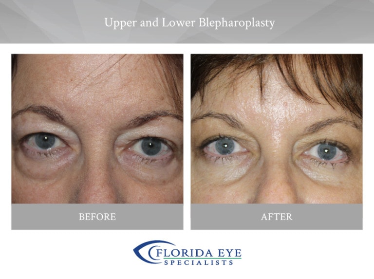 Older Woman with Upper and Lower Blepharoplasty