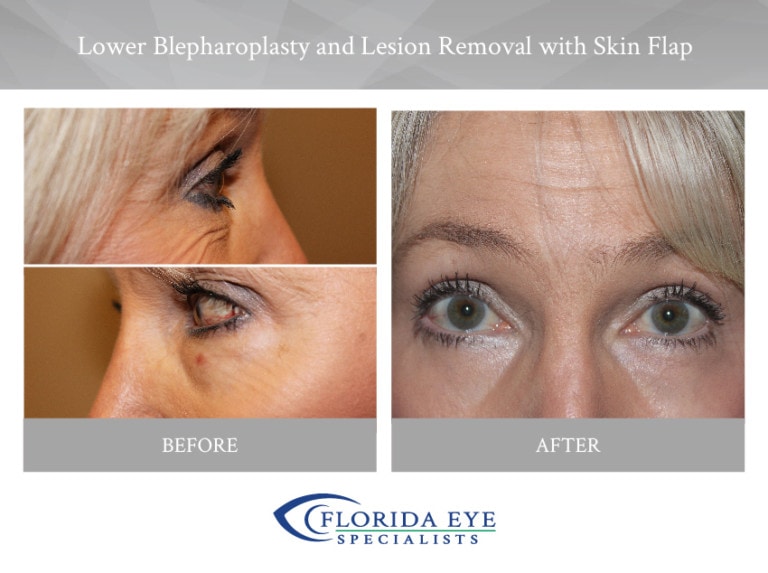 Lower Blepharoplasty Lesion Removal with Skin Flap