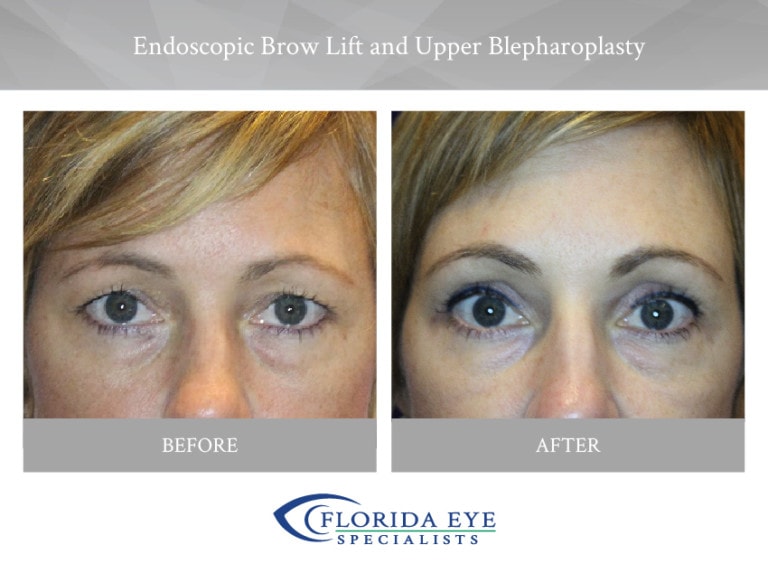 Endoscopic Brow Lift and Upper Blepharoplasty