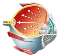 Glaucoma