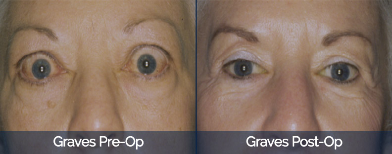 Graves’ Disease Before & After 1