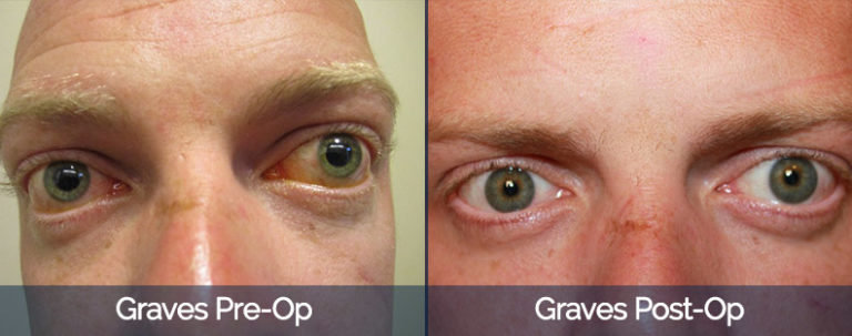 Graves’ Disease Before & After 3