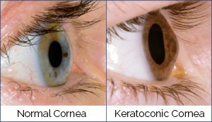 Keratoconus Cornea