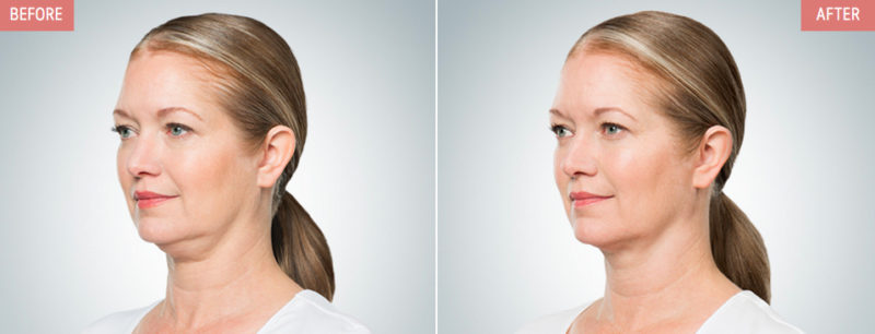 Kybella Before & After