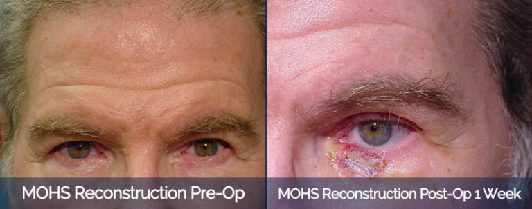 MOHS Reconstruction Before & After 1