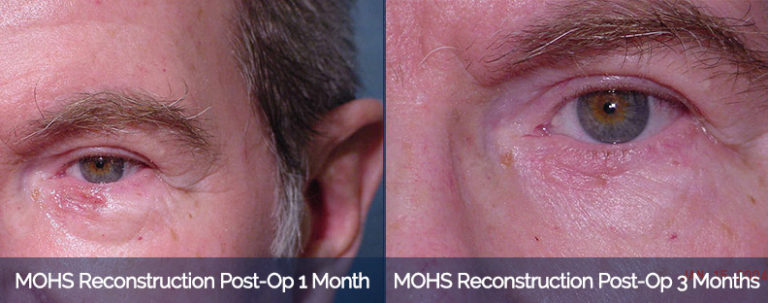 MOHS Reconstruction Before & After 2