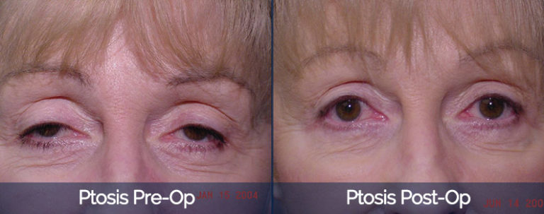 Ptosis Before & After 1