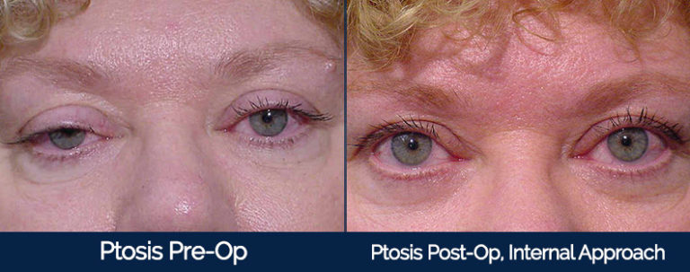 Ptosis Before & After 2